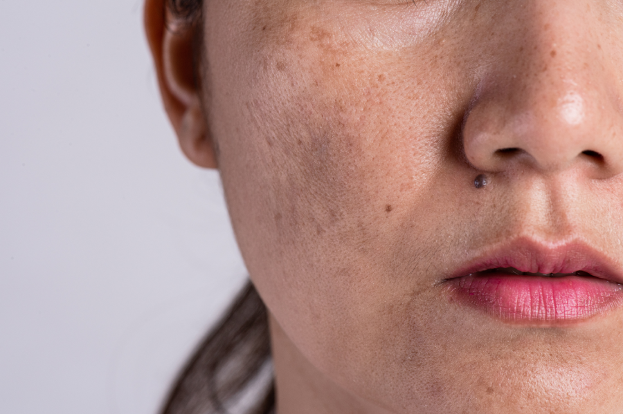 Dark Spot Reduction with NaturZest Drops 2 Dazzle